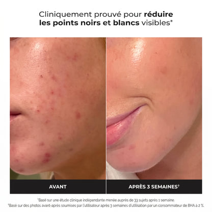Révélez une Peau Éclatante : Des Pores Nettoyés et des Ridules Lissées 118 ml
