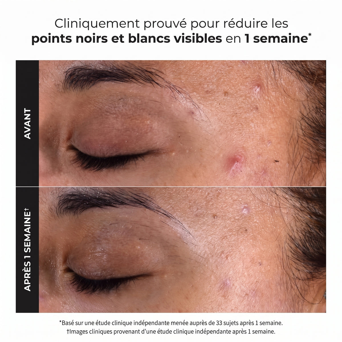Révélez une Peau Éclatante : Des Pores Nettoyés et des Ridules Lissées 118 ml
